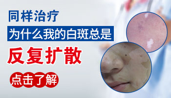 泉州儿童腰部长白癜风怎么办呢